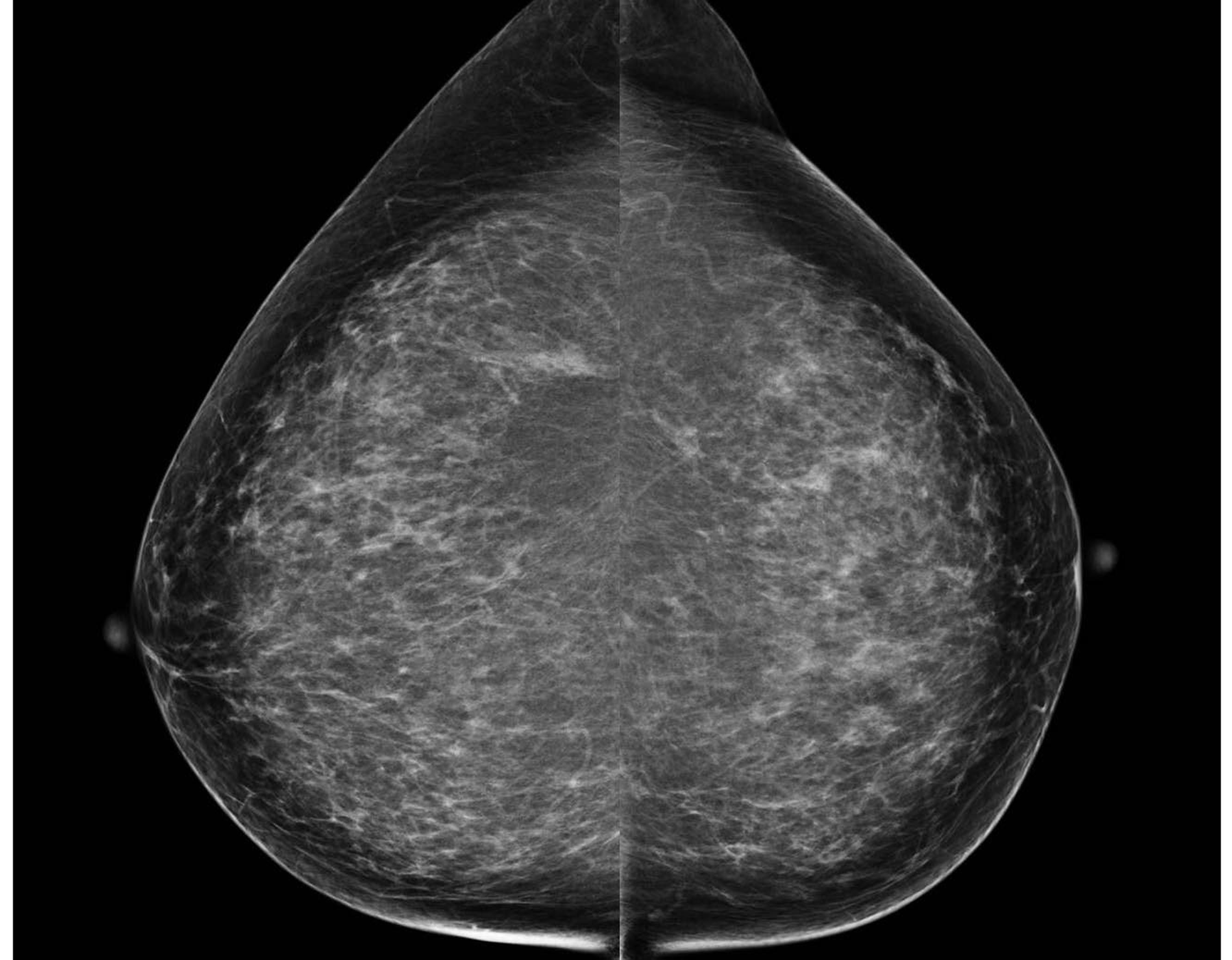 Rsna 2013 Breast Cancer Prognosis Potentially Affected By Screening